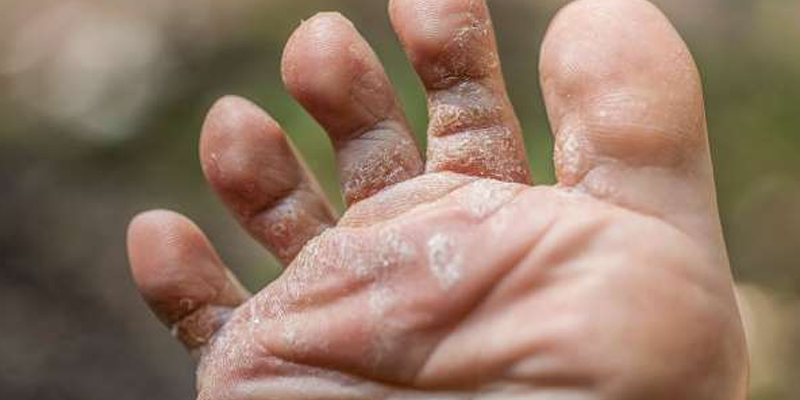 Pied d'athlète : cause et traitement de cette infection du pied